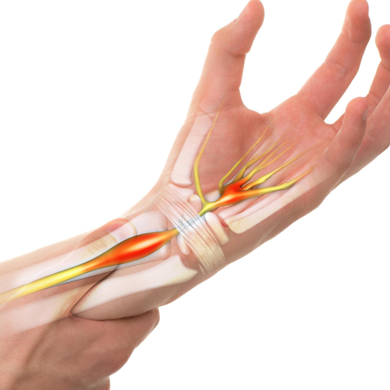 carpal tunnel treatment bay city