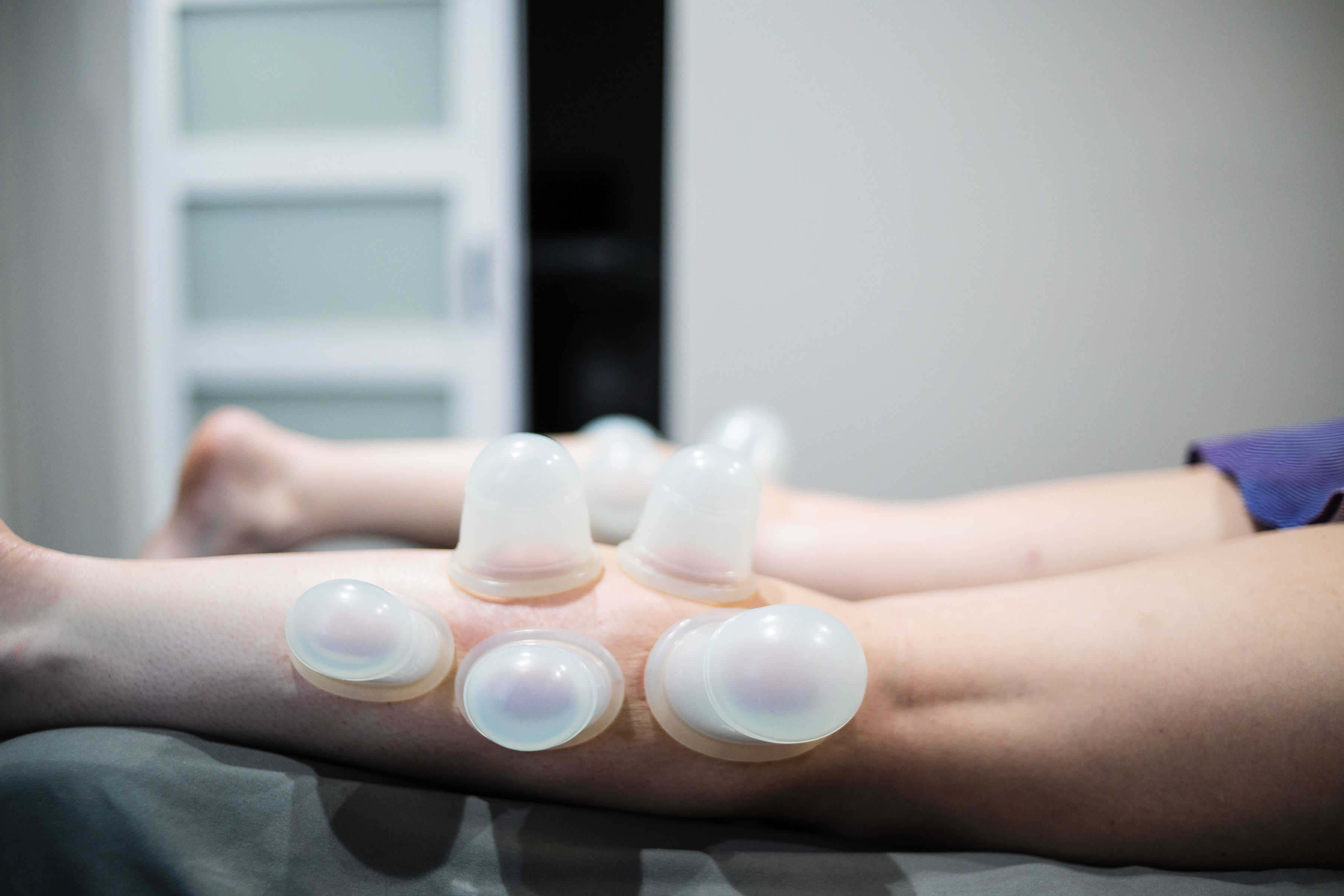 massage cups cupping