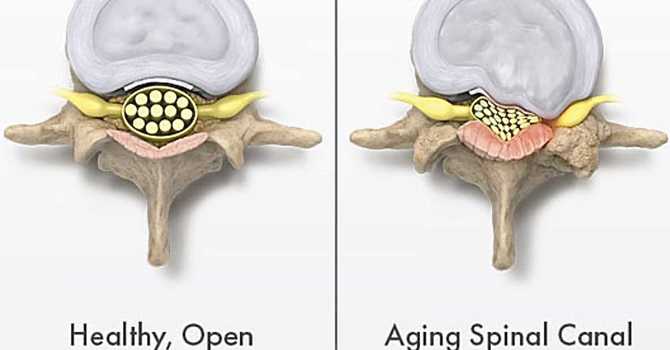 All About Spinal Stenosis  image