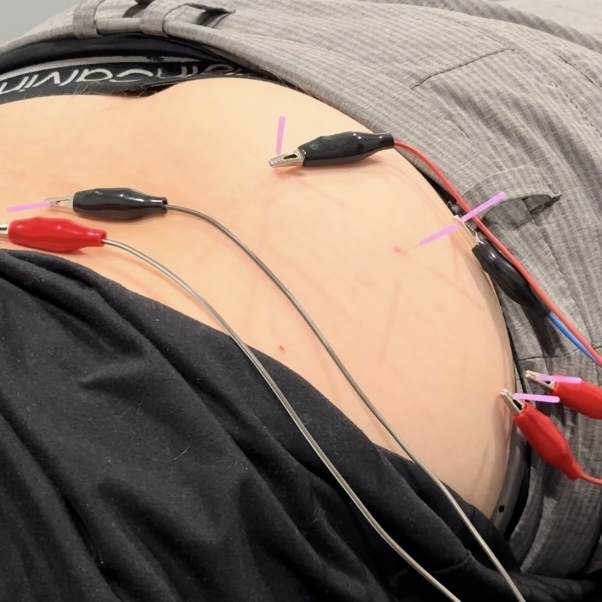 dry needling