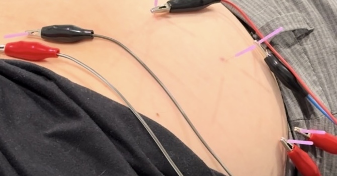 Understanding Dry Needling & Pelvic Floor Physical Therapy: image